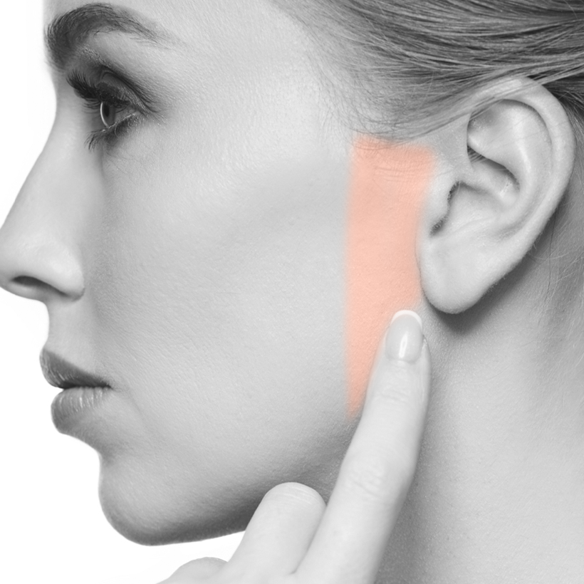 Sideburns Laser Hair Removal