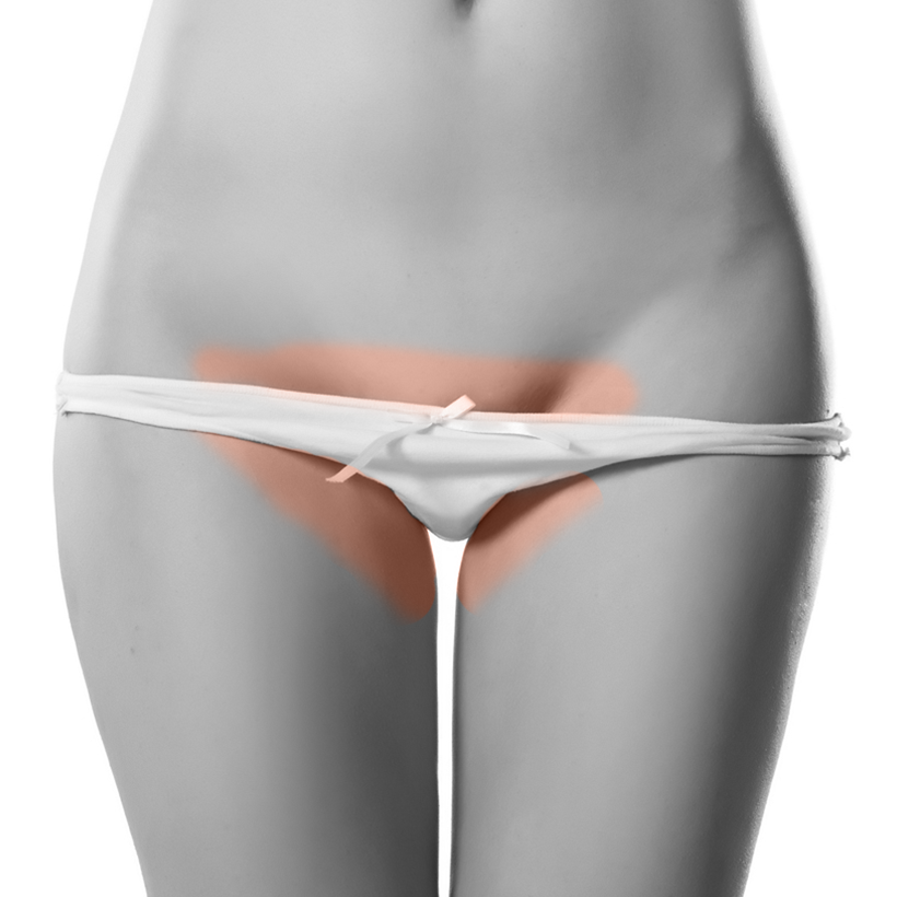 Bikini Extended Laser Hair Removal