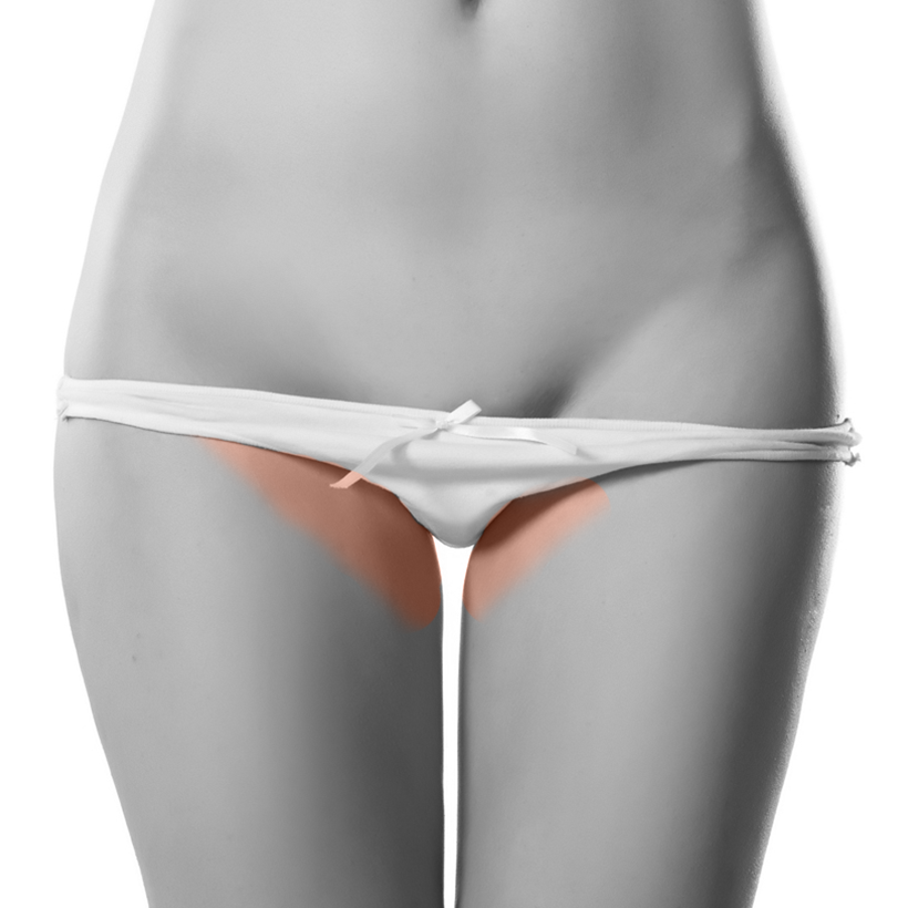 Bikini Line Laser Hair Removal