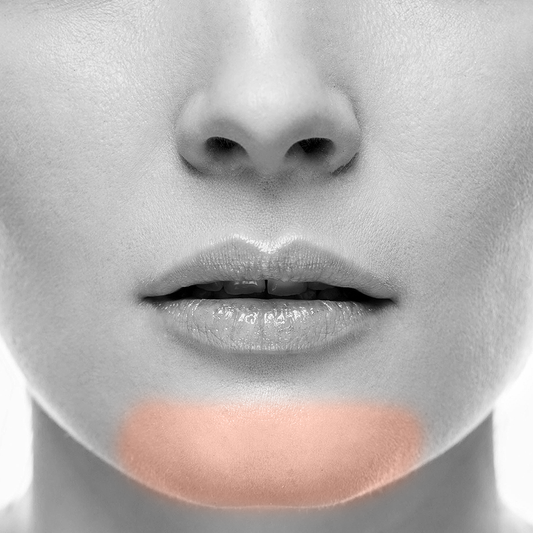 Chin Laser Hair Removal