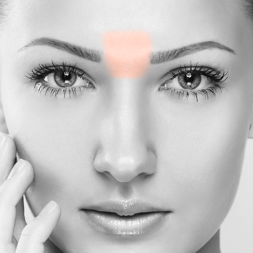 Midbrow Laser Hair Removal